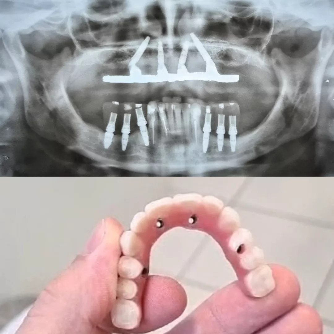 Método Áquila de Implantodontia é bom?