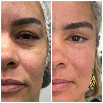 Método Olhar 4K melhor curso procedimentos estéticos para região periocular